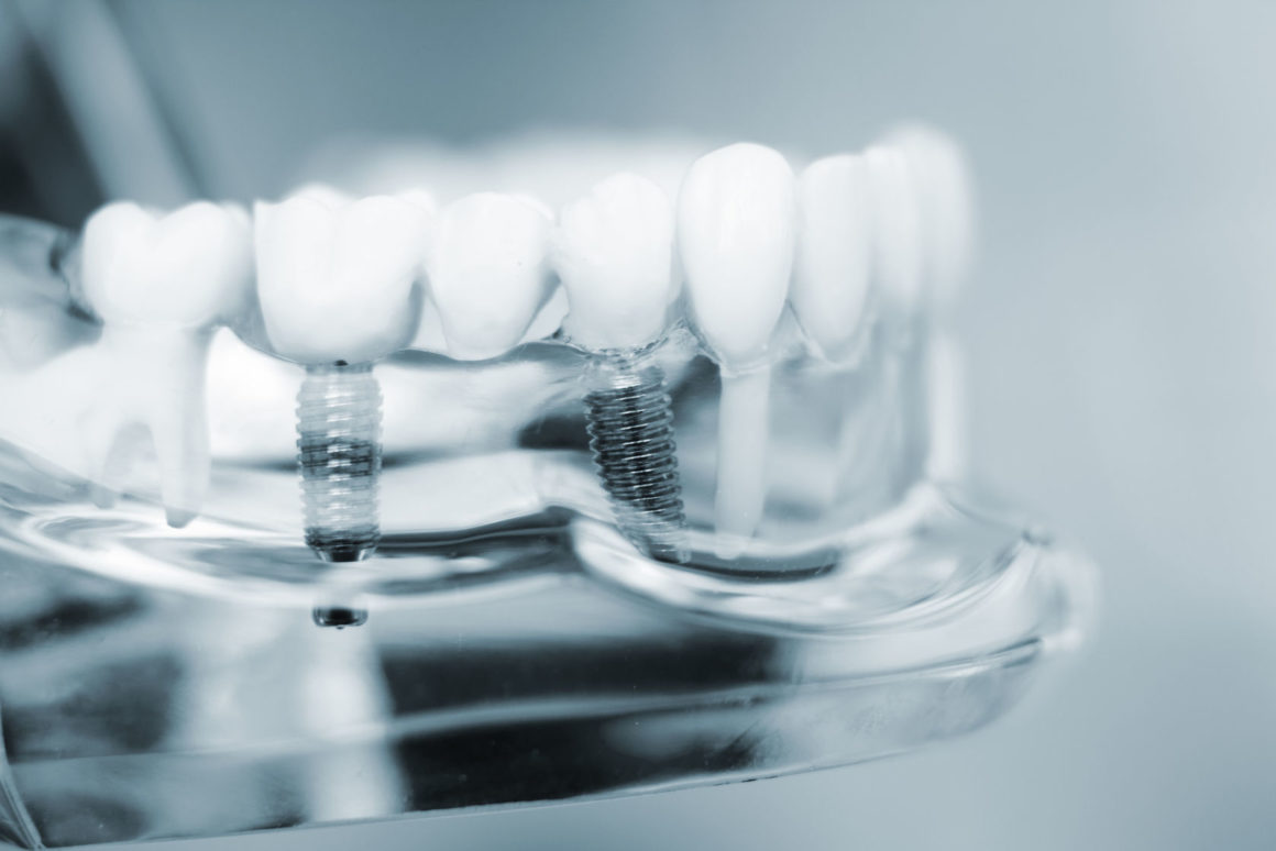 Implantologia con CEREC